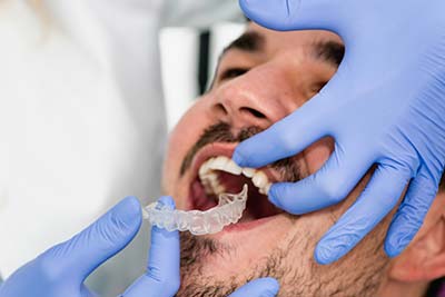 man having Invisalign aligners fitted