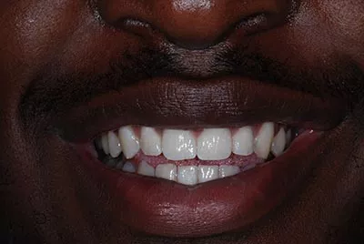 After image